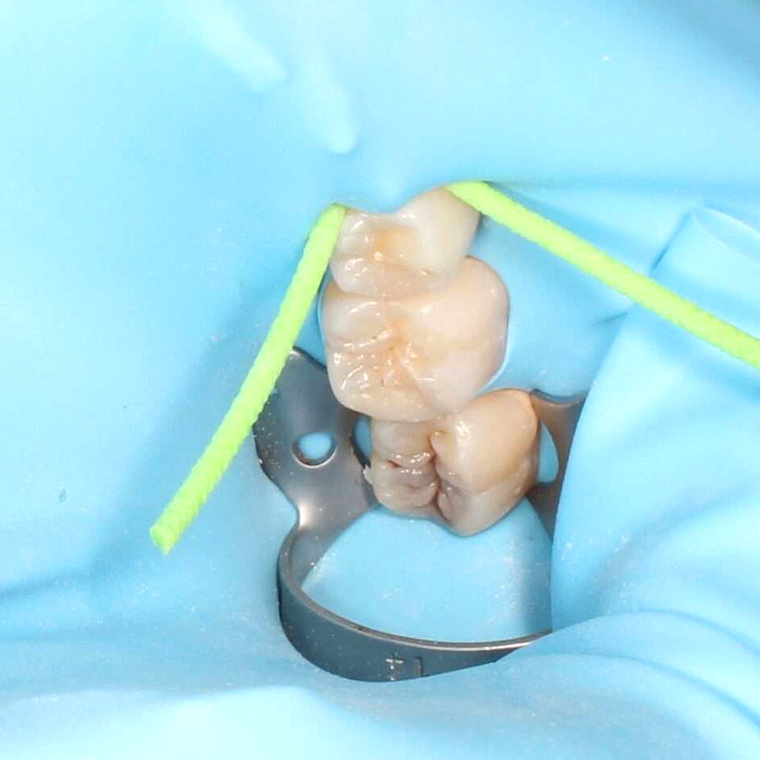 Tooth-Coloured-Fillings